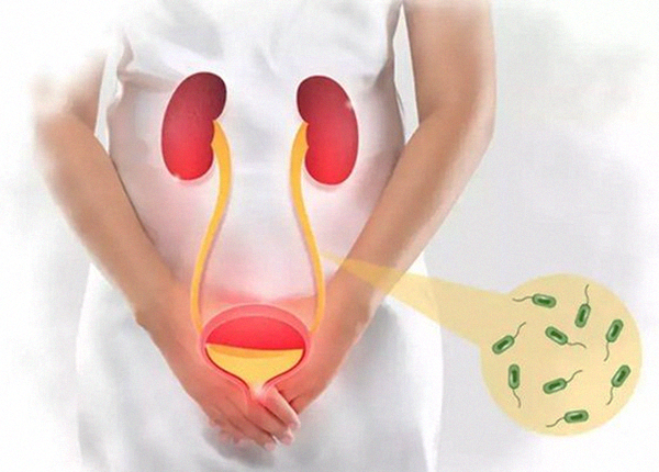 Dấu hiệu viêm bàng quang và phác đồ điều trị phòng ngừa hiệu quả